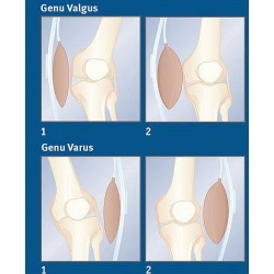 Gonartec Varus Valgus Knee Support Health And Care