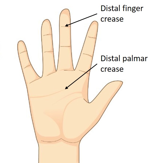 how to measure your hand for the splint