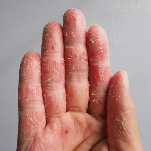 eczema on the fingers