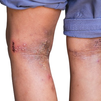 eczema on back of legs