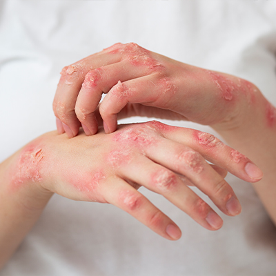 How to Get Rid of Eczema Itching