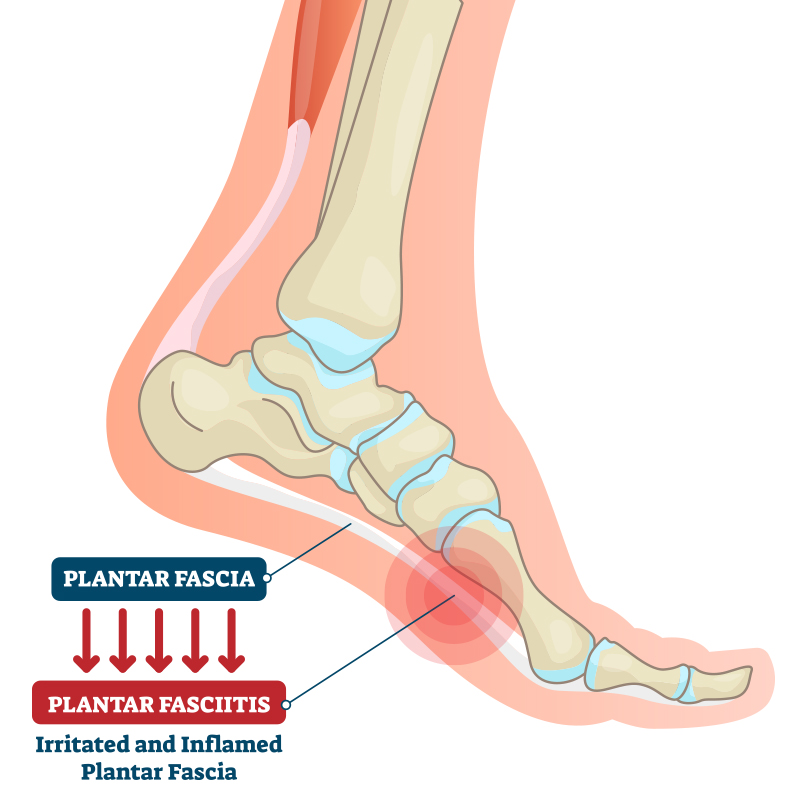 best foot insoles for heel pain