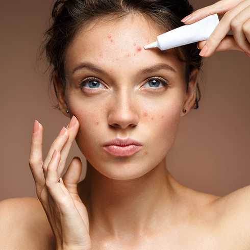 Causes, effects, and how you can prevent dreaded acne