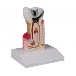 Dental Caries Model