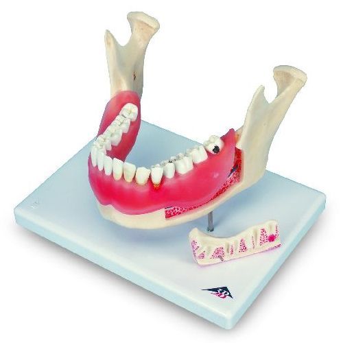 Dental Disease Magnified 2 Times 21 Parts