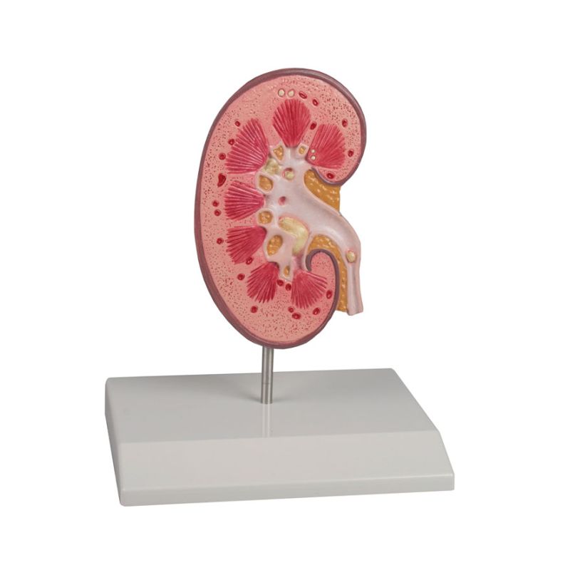 Kidney Stone Model :: Sports Supports | Mobility | Healthcare Products