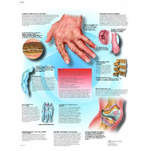 Rheumatic Diseases Chart :: Sports Supports | Mobility | Healthcare ...