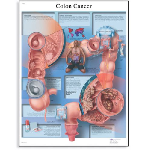 Colon Cancer Chart Deluxe