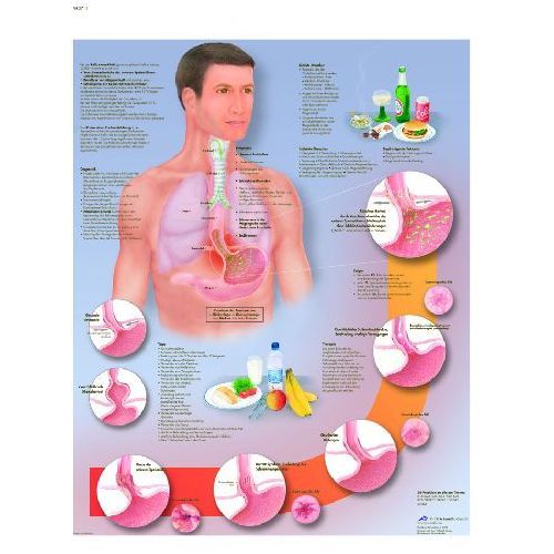 Gastroesophageal Reflux Disease Chart Gerd